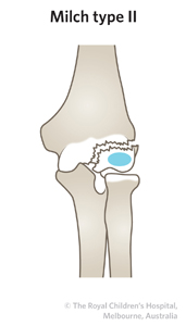 Fracture_Lateral condyle_ED_Section 2_MILCH FRACTURE 2.jpg